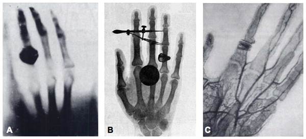 Rapid evolution of X-ray imaging. After O. Glassner, 1934