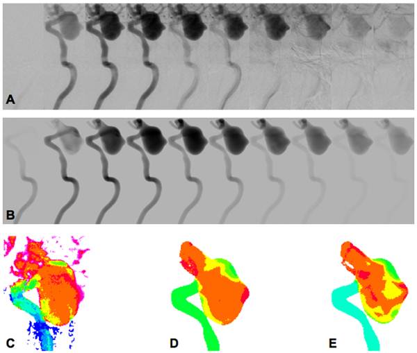 Real vs. virtual X-ray angiography. © David and Dolores Steinman